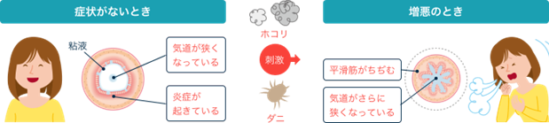 気管支喘息について