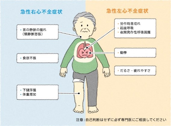 心不全のイメージ画像